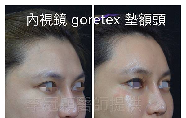 還在注射豐額頭嗎? 微創內視鏡精準豐額頭(墊額頭)不再讓妳掀 還在注射豐額頭嗎? 微創內視鏡精準豐額頭(墊額頭)不再讓妳掀