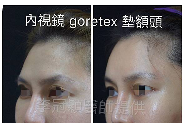 還在注射豐額頭嗎? 微創內視鏡精準豐額頭(墊額頭)不再讓妳掀 還在注射豐額頭嗎? 微創內視鏡精準豐額頭(墊額頭)不再讓妳掀