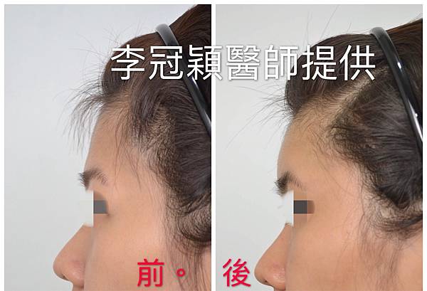 還在注射豐額頭嗎? 微創內視鏡精準豐額頭(墊額頭)不再讓妳掀 還在注射豐額頭嗎? 微創內視鏡精準豐額頭(墊額頭)不再讓妳掀