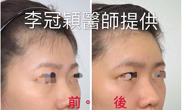 還在注射豐額頭嗎? 微創內視鏡精準豐額頭(墊額頭)不再讓妳掀 還在注射豐額頭嗎? 微創內視鏡精準豐額頭(墊額頭)不再讓妳掀