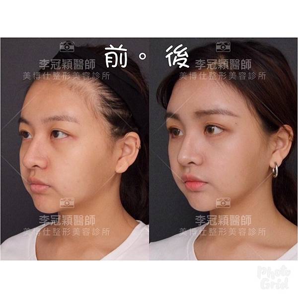 還在注射豐額頭嗎? 微創內視鏡精準豐額頭(墊額頭)不再讓妳掀 還在注射豐額頭嗎? 微創內視鏡精準豐額頭(墊額頭)不再讓妳掀