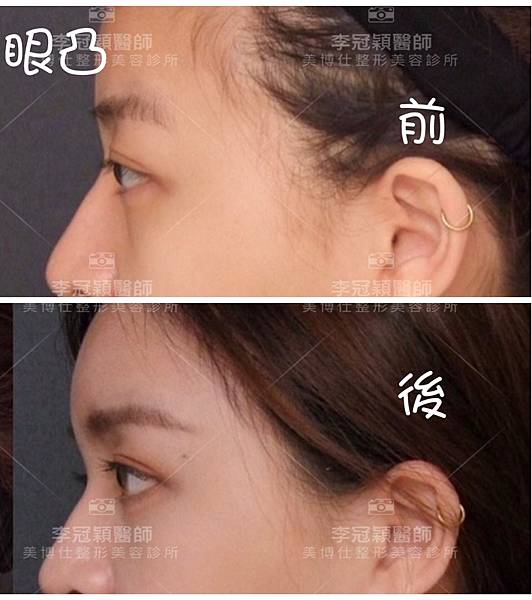 還在注射豐額頭嗎? 微創內視鏡精準豐額頭(墊額頭)不再讓妳掀 還在注射豐額頭嗎? 微創內視鏡精準豐額頭(墊額頭)不再讓妳掀