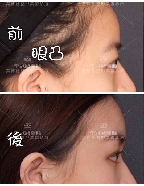 還在注射豐額頭嗎? 微創內視鏡精準豐額頭(墊額頭)不再讓妳掀 還在注射豐額頭嗎? 微創內視鏡精準豐額頭(墊額頭)不再讓妳掀