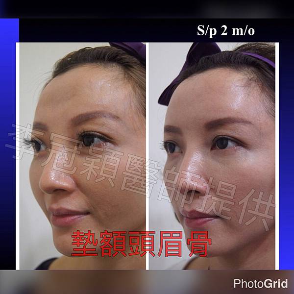 還在注射豐額頭嗎? 微創內視鏡精準豐額頭(墊額頭)不再讓妳掀 還在注射豐額頭嗎? 微創內視鏡精準豐額頭(墊額頭)不再讓妳掀