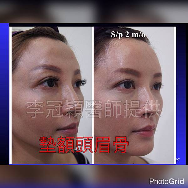 還在注射豐額頭嗎? 微創內視鏡精準豐額頭(墊額頭)不再讓妳掀 還在注射豐額頭嗎? 微創內視鏡精準豐額頭(墊額頭)不再讓妳掀