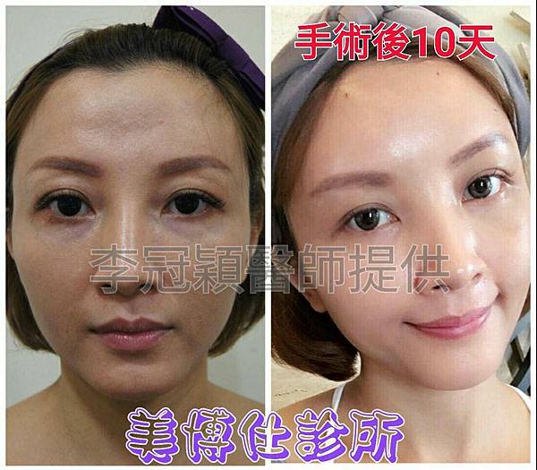 還在注射豐額頭嗎? 微創內視鏡精準豐額頭(墊額頭)不再讓妳掀 還在注射豐額頭嗎? 微創內視鏡精準豐額頭(墊額頭)不再讓妳掀