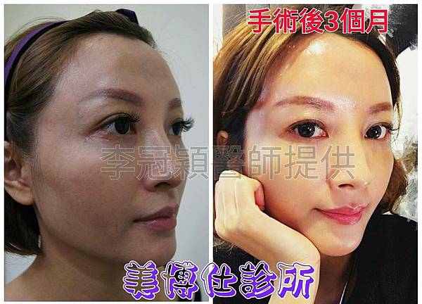 還在注射豐額頭嗎? 微創內視鏡精準豐額頭(墊額頭)不再讓妳掀 還在注射豐額頭嗎? 微創內視鏡精準豐額頭(墊額頭)不再讓妳掀