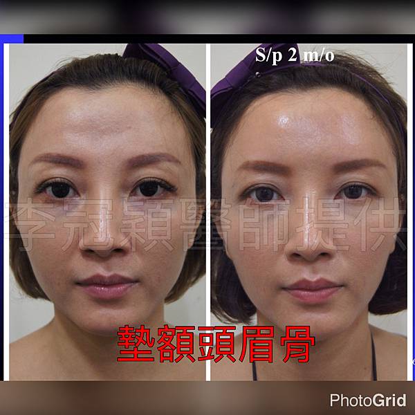 還在注射豐額頭嗎? 微創內視鏡精準豐額頭(墊額頭)不再讓妳掀 還在注射豐額頭嗎? 微創內視鏡精準豐額頭(墊額頭)不再讓妳掀