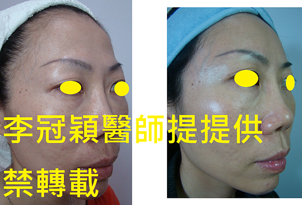 還在注射豐額頭嗎? 微創內視鏡精準豐額頭(墊額頭)不再讓妳掀 還在注射豐額頭嗎? 微創內視鏡精準豐額頭(墊額頭)不再讓妳掀
