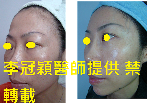 還在注射豐額頭嗎? 微創內視鏡精準豐額頭(墊額頭)不再讓妳掀 還在注射豐額頭嗎? 微創內視鏡精準豐額頭(墊額頭)不再讓妳掀