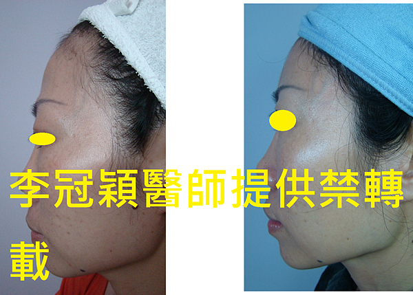 還在注射豐額頭嗎? 微創內視鏡精準豐額頭(墊額頭)不再讓妳掀 還在注射豐額頭嗎? 微創內視鏡精準豐額頭(墊額頭)不再讓妳掀