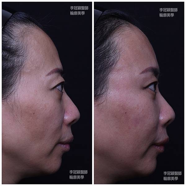 還在注射豐額頭嗎? 微創內視鏡精準豐額頭(墊額頭)不再讓妳掀 還在注射豐額頭嗎? 微創內視鏡精準豐額頭(墊額頭)不再讓妳掀