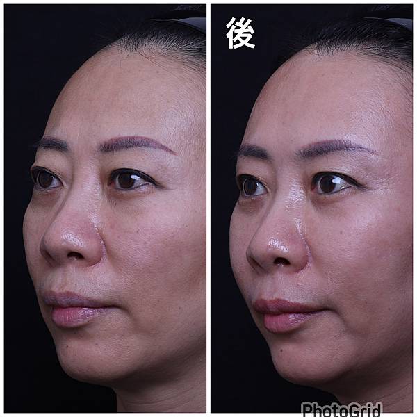 還在注射豐額頭嗎? 微創內視鏡精準豐額頭(墊額頭)不再讓妳掀 還在注射豐額頭嗎? 微創內視鏡精準豐額頭(墊額頭)不再讓妳掀