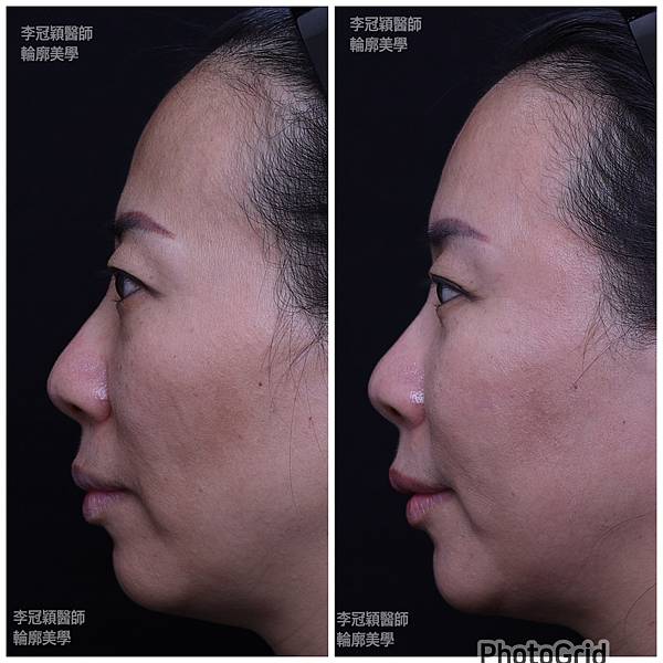 還在注射豐額頭嗎? 微創內視鏡精準豐額頭(墊額頭)不再讓妳掀 還在注射豐額頭嗎? 微創內視鏡精準豐額頭(墊額頭)不再讓妳掀
