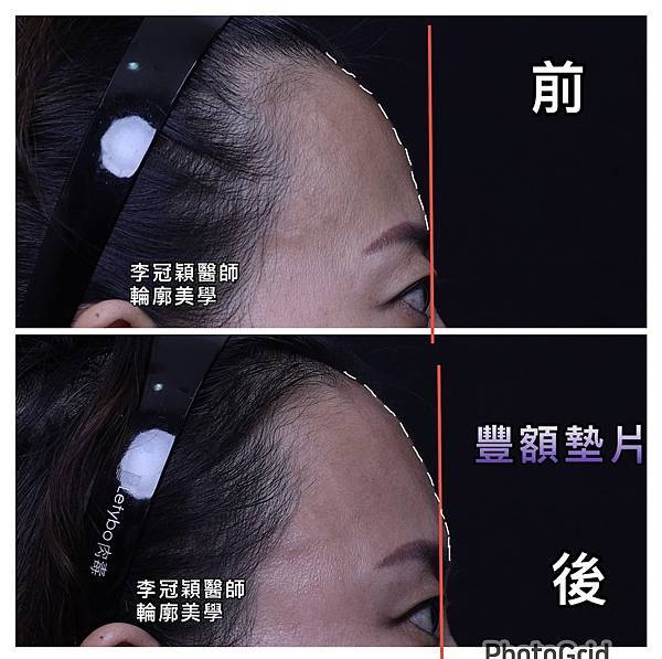 還在注射豐額頭嗎? 微創內視鏡精準豐額頭(墊額頭)不再讓妳掀 還在注射豐額頭嗎? 微創內視鏡精準豐額頭(墊額頭)不再讓妳掀