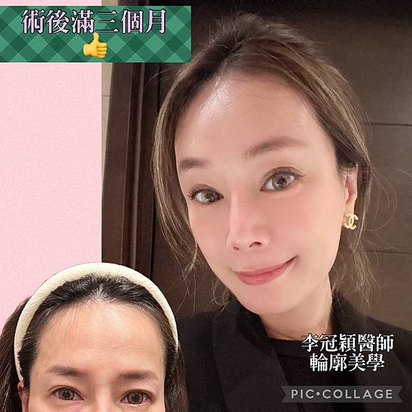 還在注射豐額頭嗎? 微創內視鏡精準豐額頭(墊額頭)不再讓妳掀 還在注射豐額頭嗎? 微創內視鏡精準豐額頭(墊額頭)不再讓妳掀