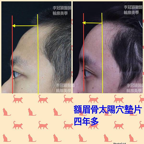 還在注射豐額頭嗎? 微創內視鏡精準豐額頭(墊額頭)不再讓妳掀 還在注射豐額頭嗎? 微創內視鏡精準豐額頭(墊額頭)不再讓妳掀