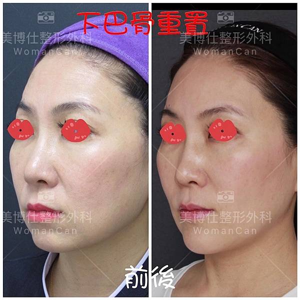 除了小Ｖ臉，妳還少了什麼？側臉的顏值骨性線條-下顎線，下巴線