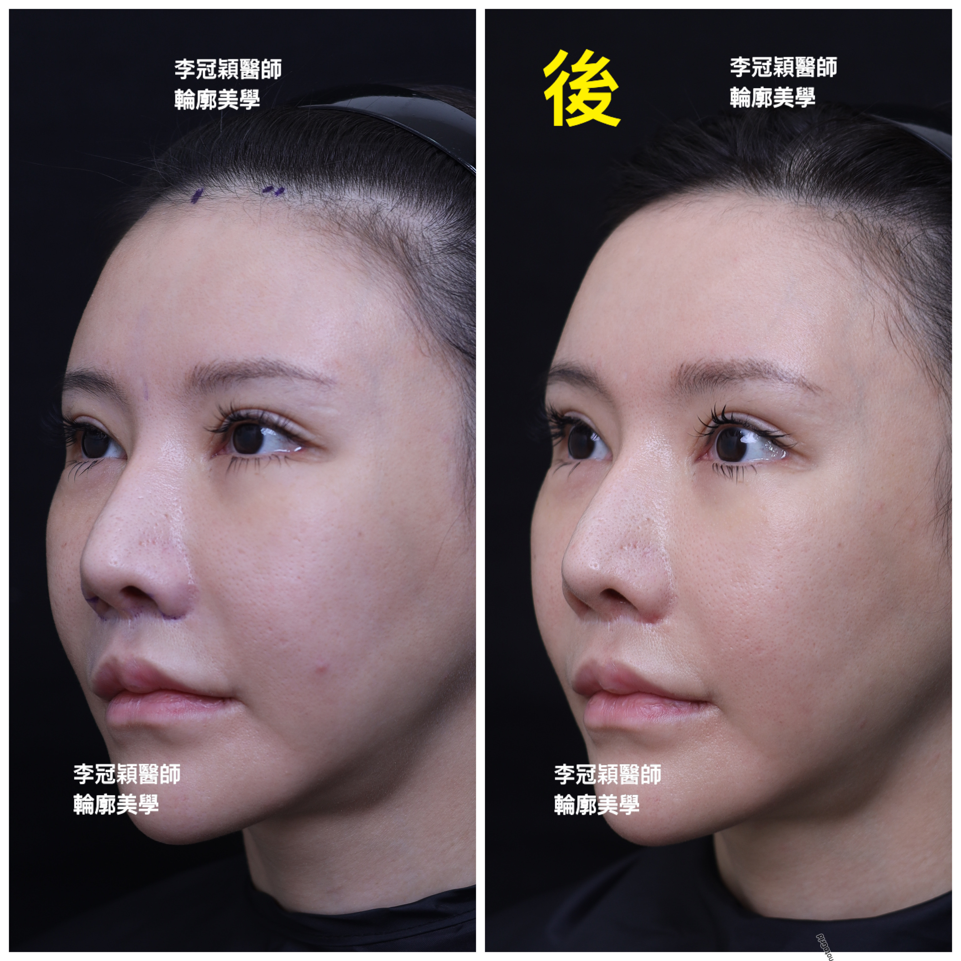 妳的豐額是哪一款的？雕塑輪廓額、假體凸額還是注射膨額？眉骨的