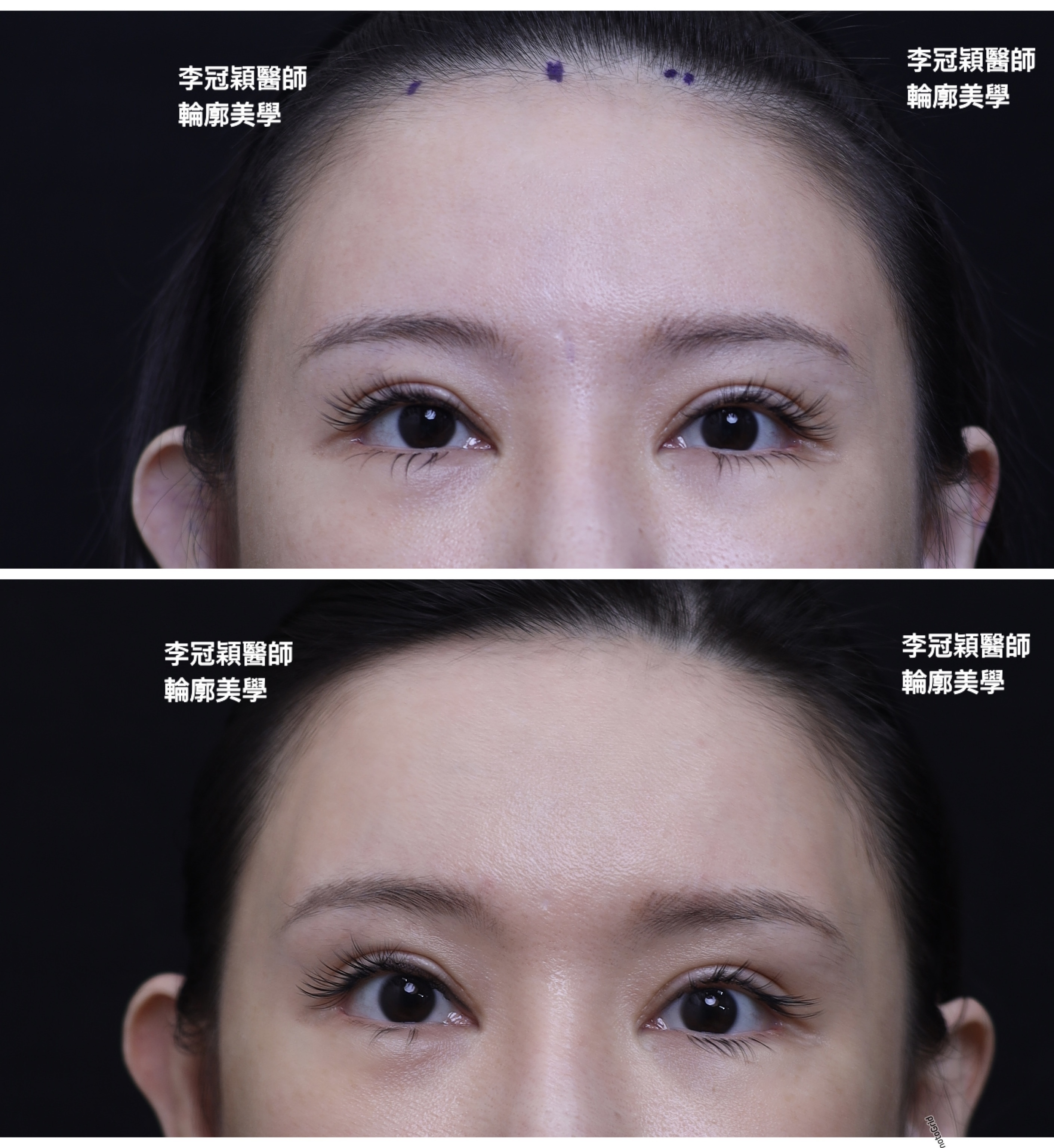 妳的豐額是哪一款的？雕塑輪廓額、假體凸額還是注射膨額？眉骨的