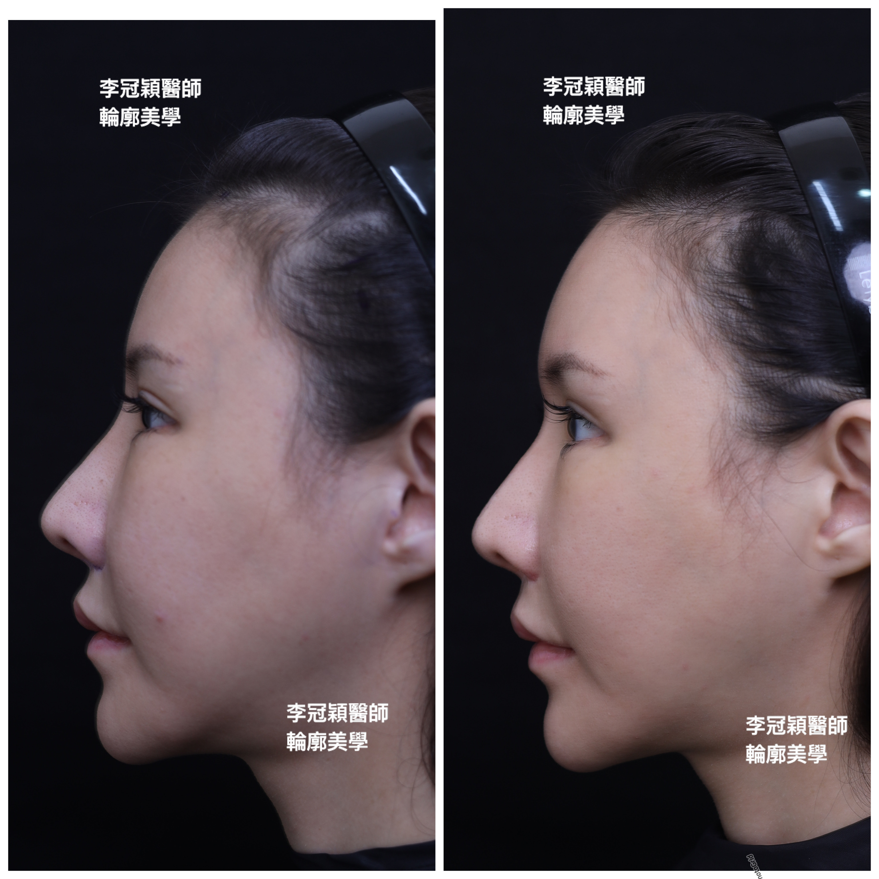 妳的豐額是哪一款的？雕塑輪廓額、假體凸額還是注射膨額？眉骨的