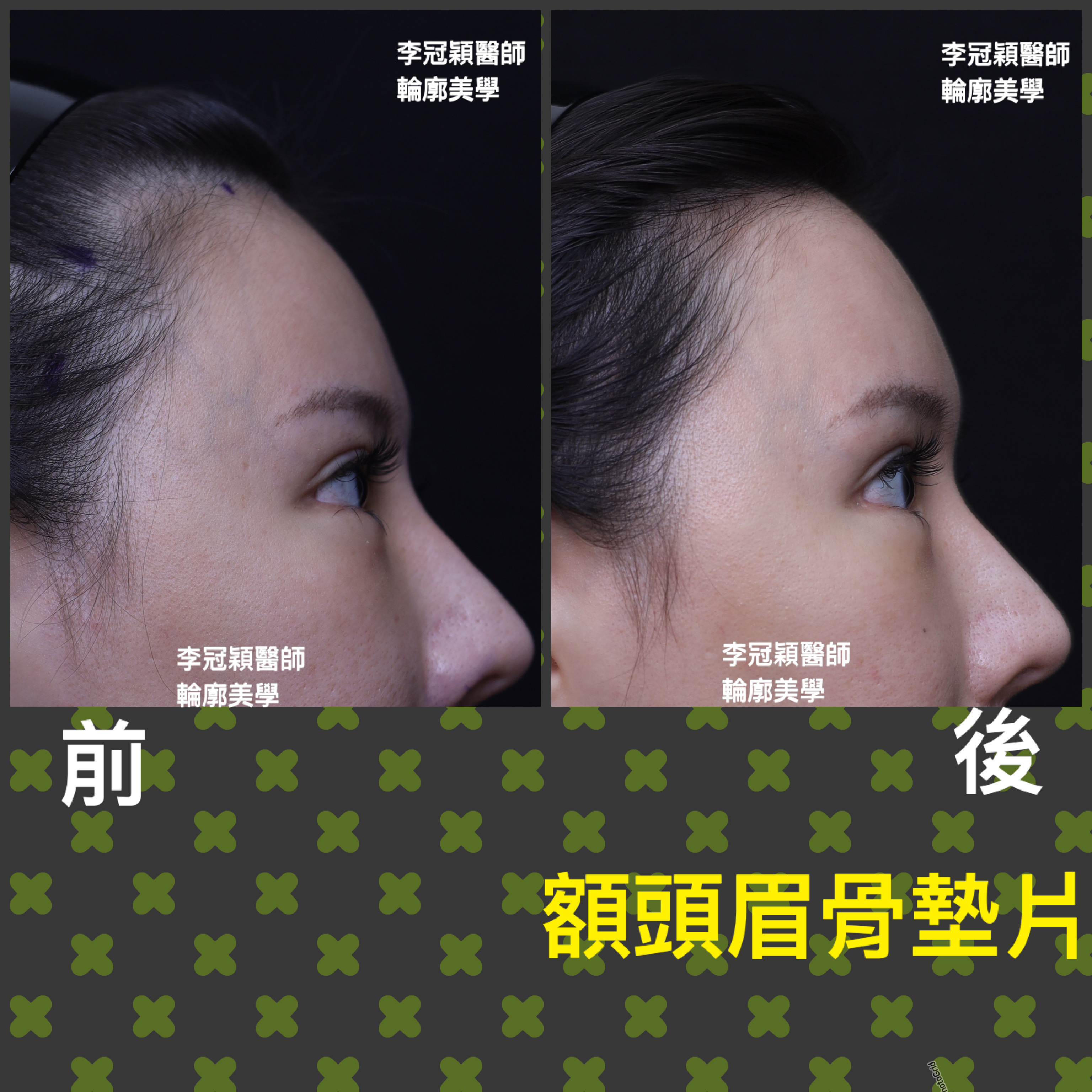 妳的豐額是哪一款的？雕塑輪廓額、假體凸額還是注射膨額？眉骨的