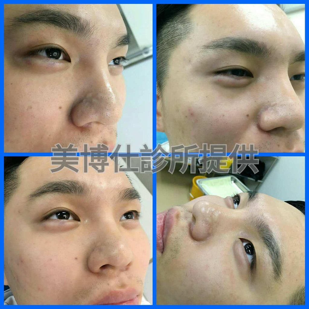 李冠穎醫師男性臥蠶手術