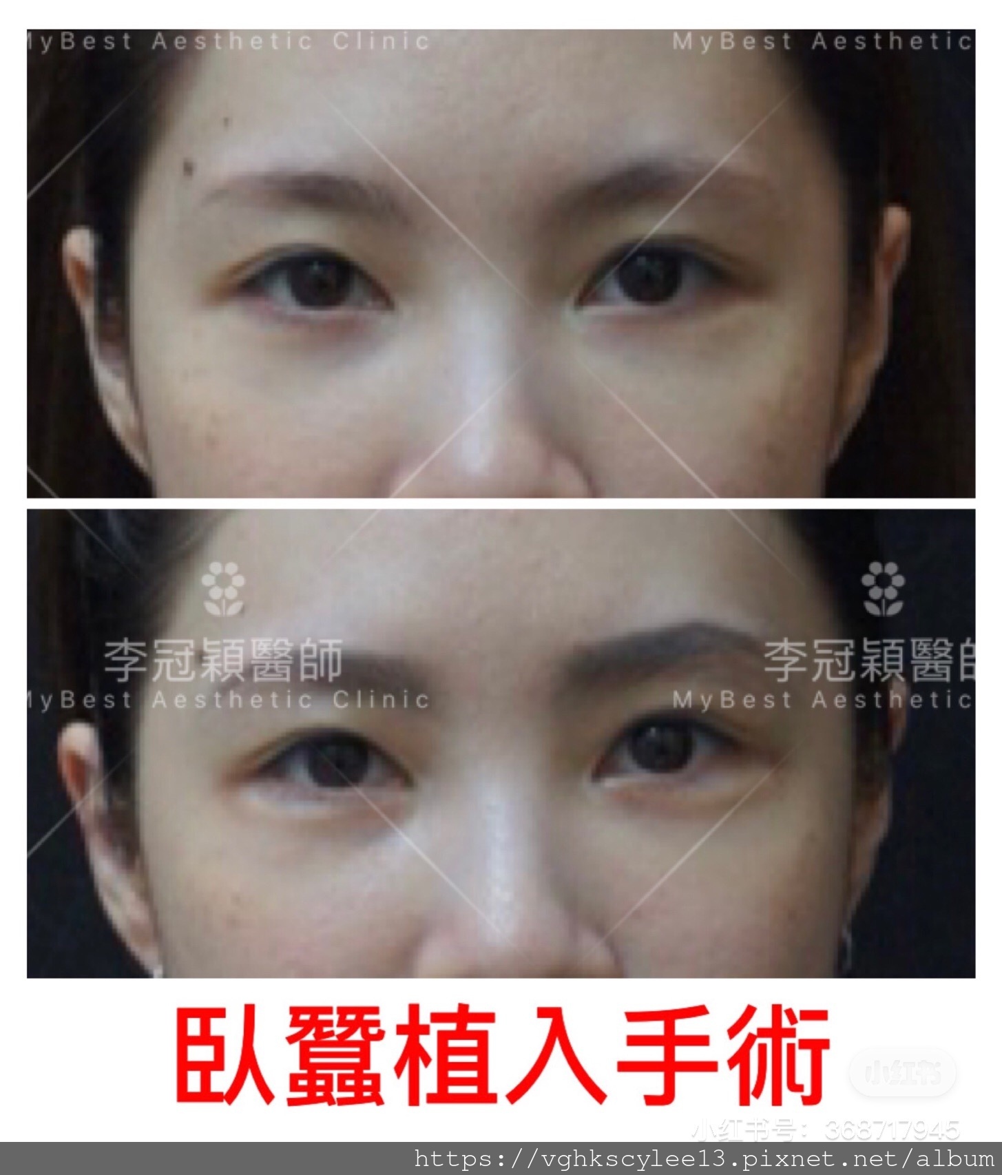 IMG_7385.JPG 高雄李冠穎醫師臥蠶植入手術