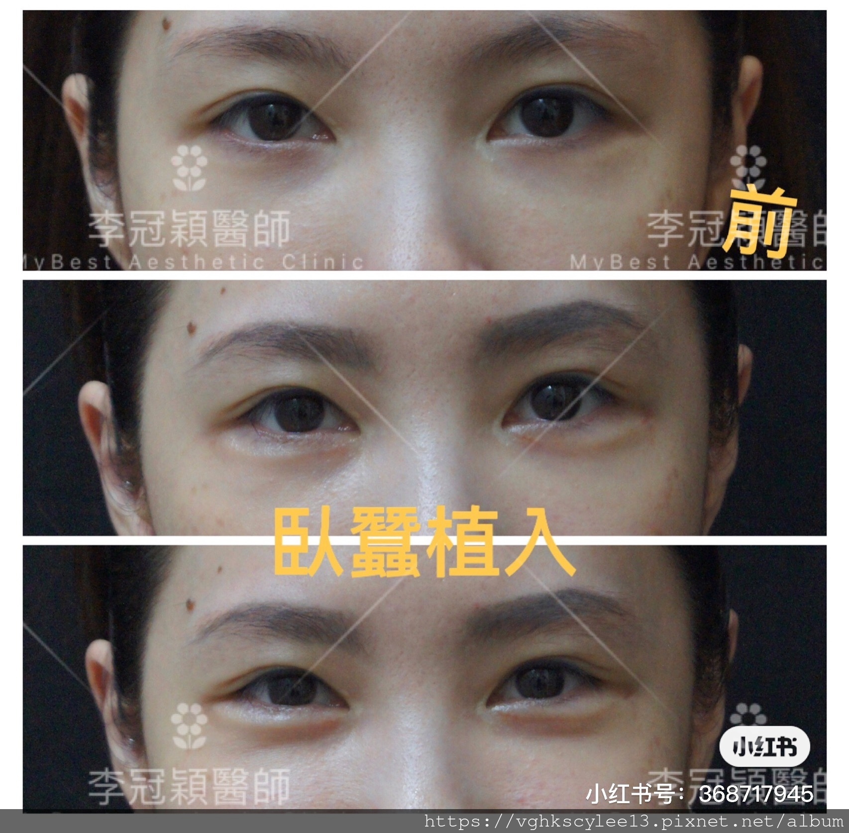 IMG_7386.JPG 高雄李冠穎醫師臥蠶植入手術