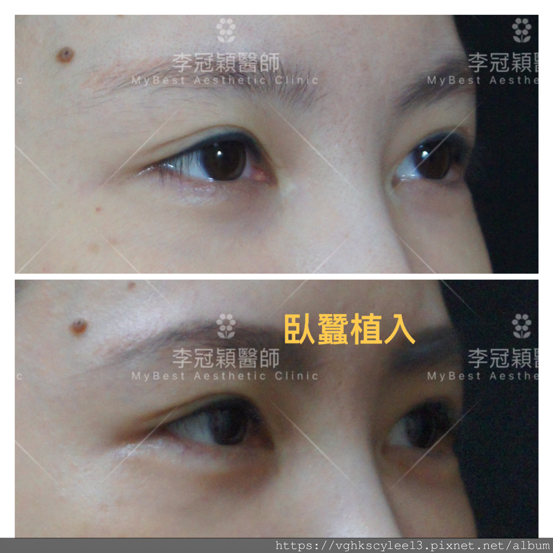 IMG_7397.PNG 高雄李冠穎醫師臥蠶植入手術