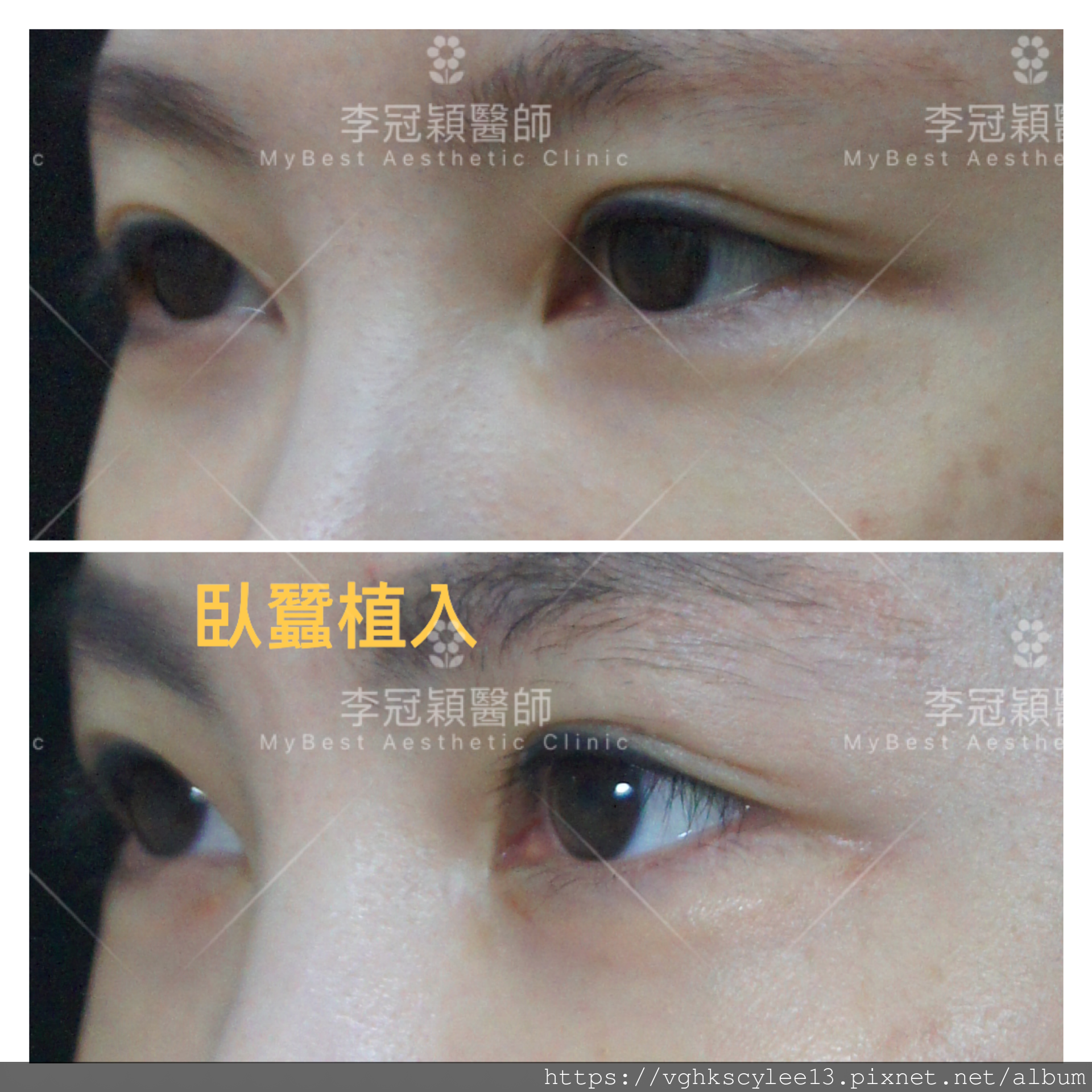 IMG_7398.PNG 高雄李冠穎醫師臥蠶植入手術