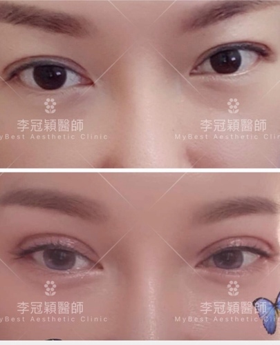 大小眼的原因與大小眼矯正治療 IMG_8167.JPG - 眼鼻眼頭