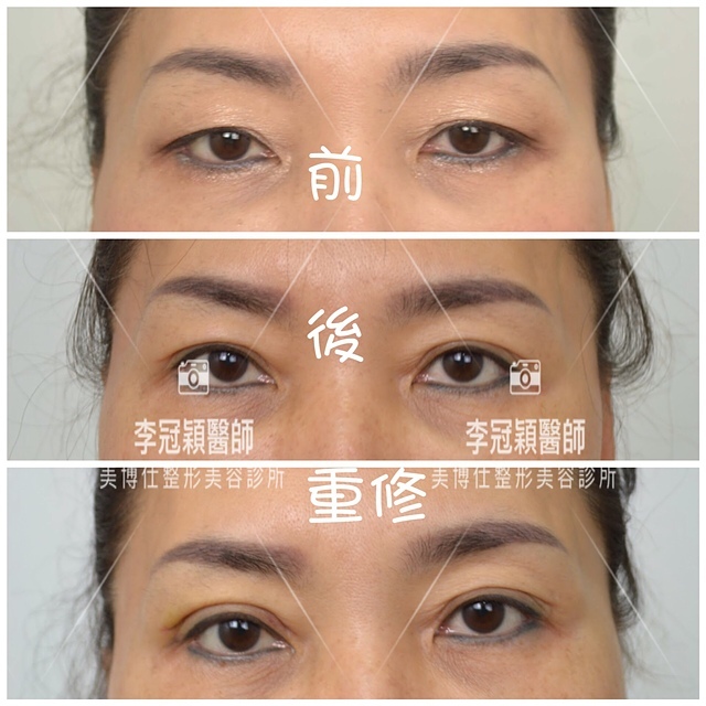 大小眼的原因與大小眼矯正治療 A75EBA39-CFB2-4779-9519-24F24CA85D97.jpeg - 眼鼻眼頭