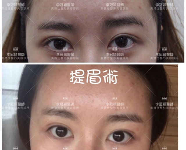 大小眼的原因與大小眼矯正治療 大小眼的原因與大小眼矯正治療