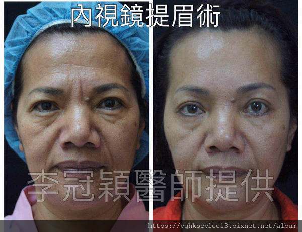 大小眼的原因與大小眼矯正治療 大小眼的原因與大小眼矯正治療