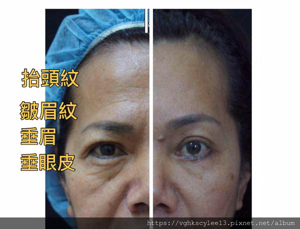 五爪提眉手術與髮際線影響