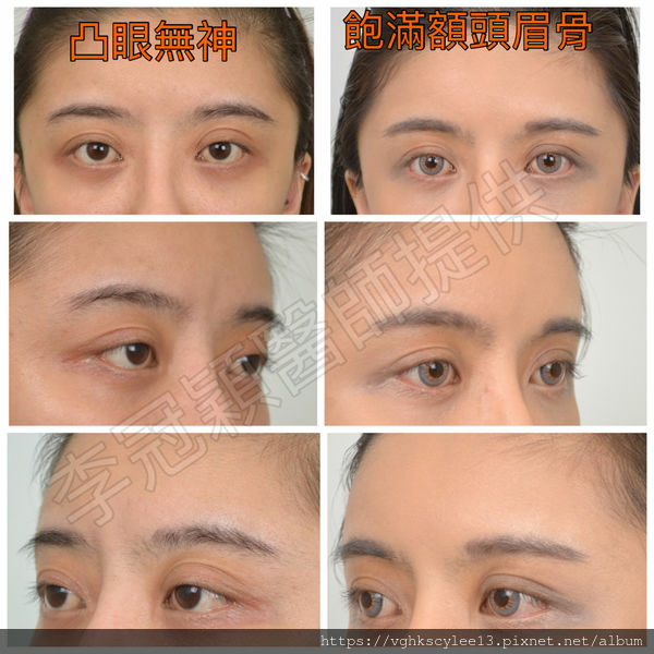 大小眼的原因與大小眼矯正治療 大小眼的原因與大小眼矯正治療