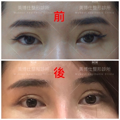 大小眼的原因與大小眼矯正治療 IMG_5999.JPG - 眼鼻眼頭