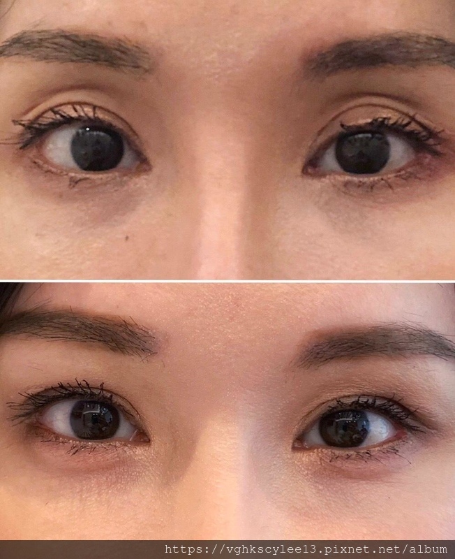 大小眼的原因與大小眼矯正治療 大小眼的原因與大小眼矯正治療