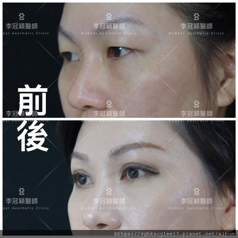 割眼皮（開放式）手術如何決定？改善眼皮下垂如何保留單眼皮與自然？