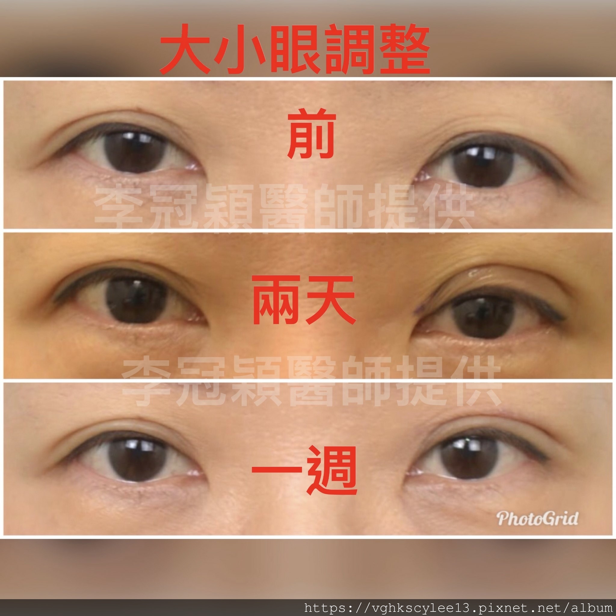 大小眼的原因與大小眼矯正治療 大小眼的原因與大小眼矯正治療