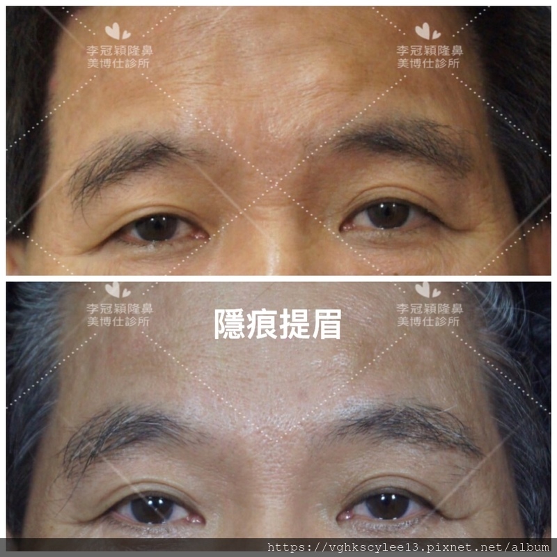 大小眼的原因與大小眼矯正治療 大小眼的原因與大小眼矯正治療