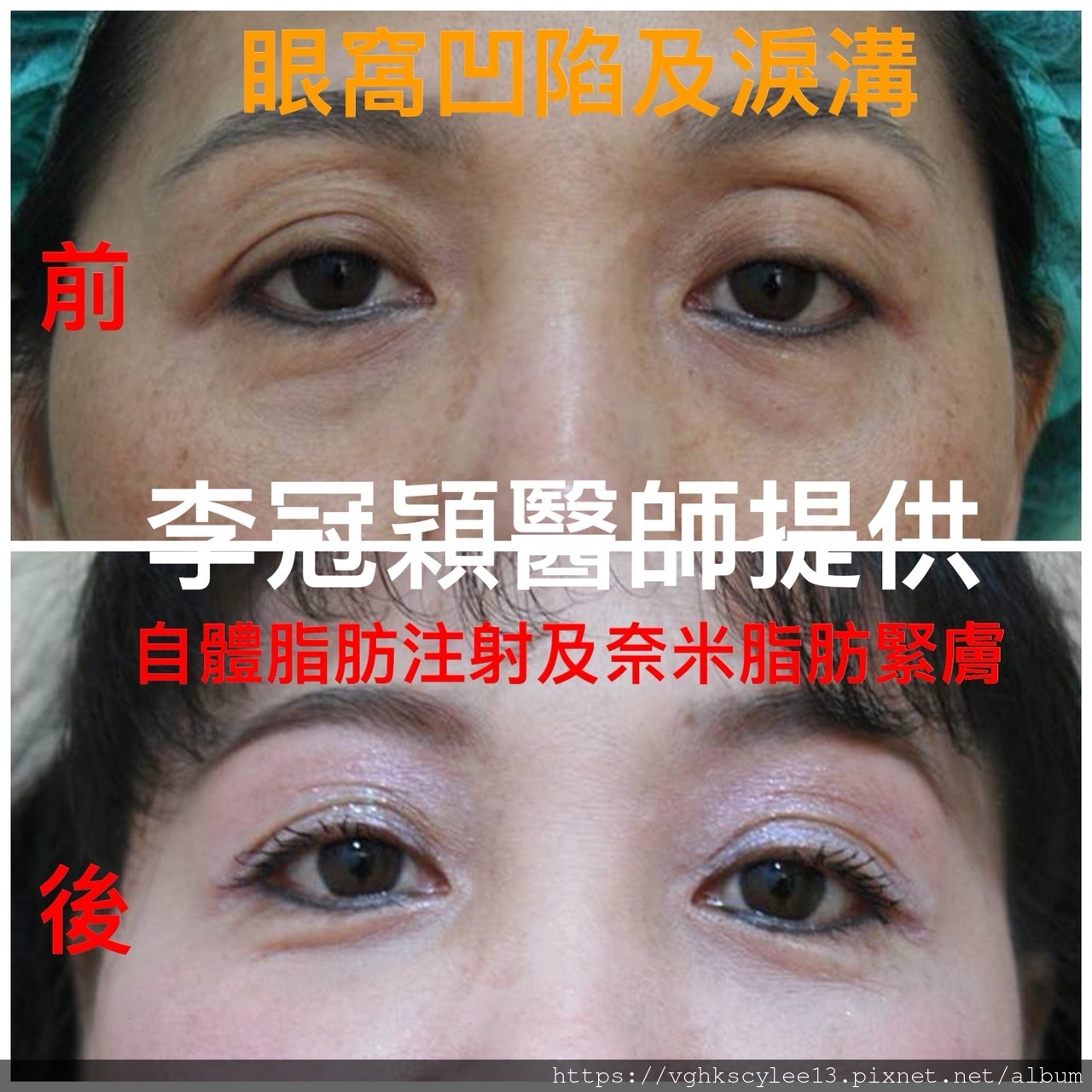 大小眼的原因與大小眼矯正治療 大小眼的原因與大小眼矯正治療