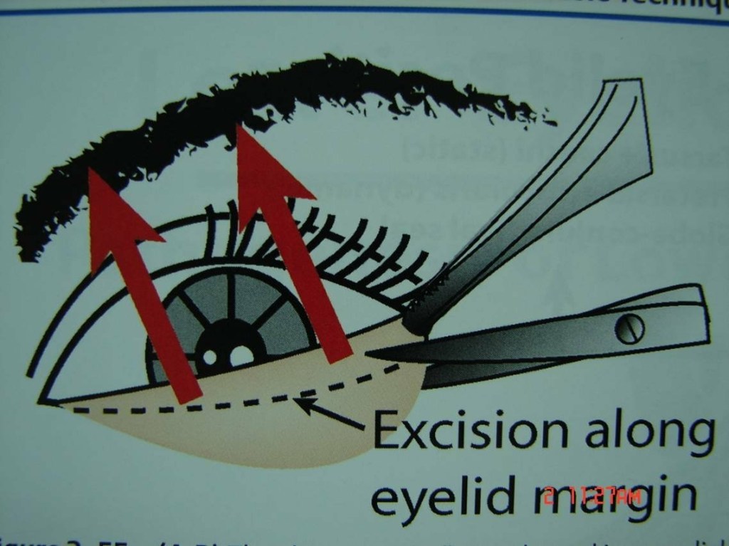 甚麼是眼袋，怎麼處理?