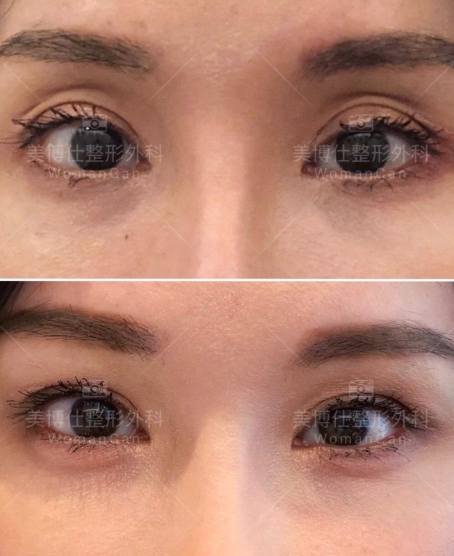 大小眼的原因與大小眼矯正治療 大小眼的原因與大小眼矯正治療