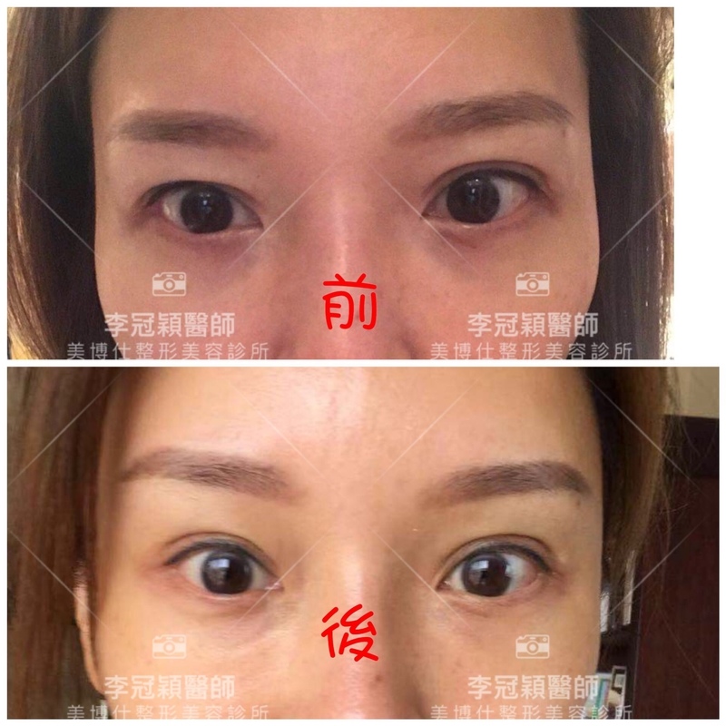 大小眼的原因與大小眼矯正治療 大小眼的原因與大小眼矯正治療