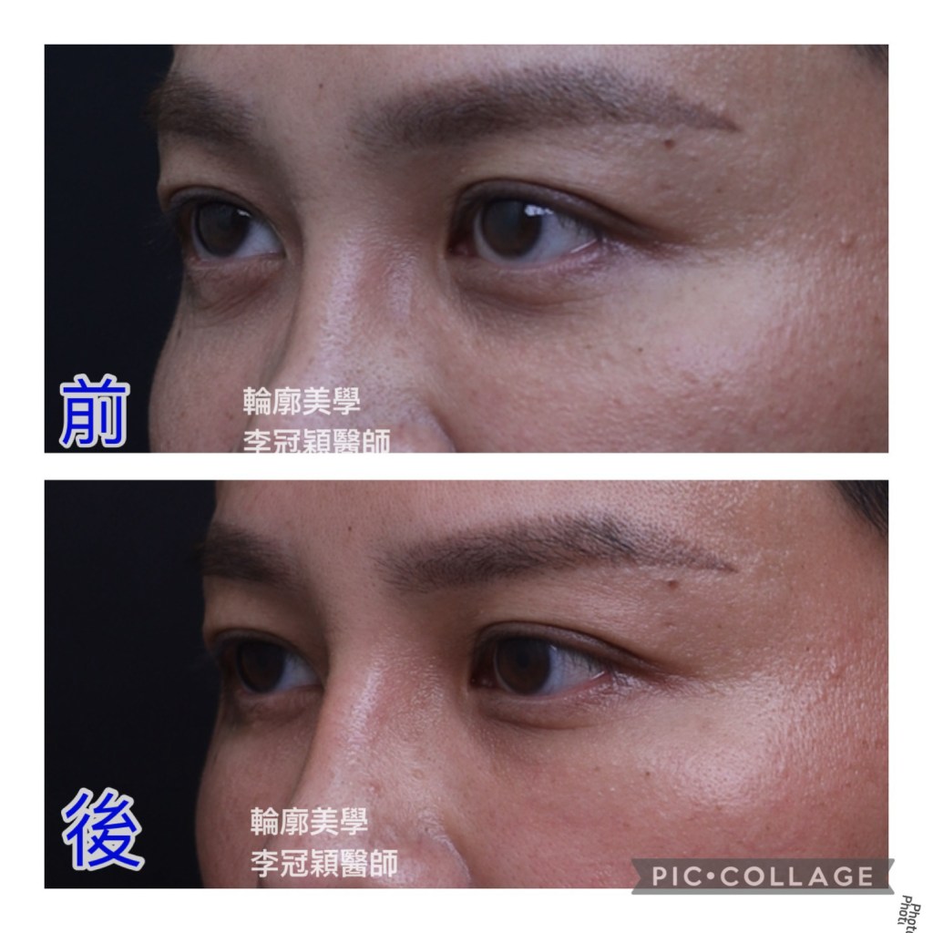 臉部傷疤,眼袋與鼻部重修手術