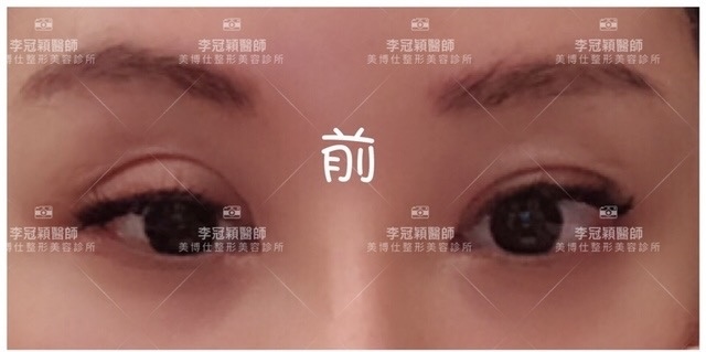 大小眼的成因與解決方法