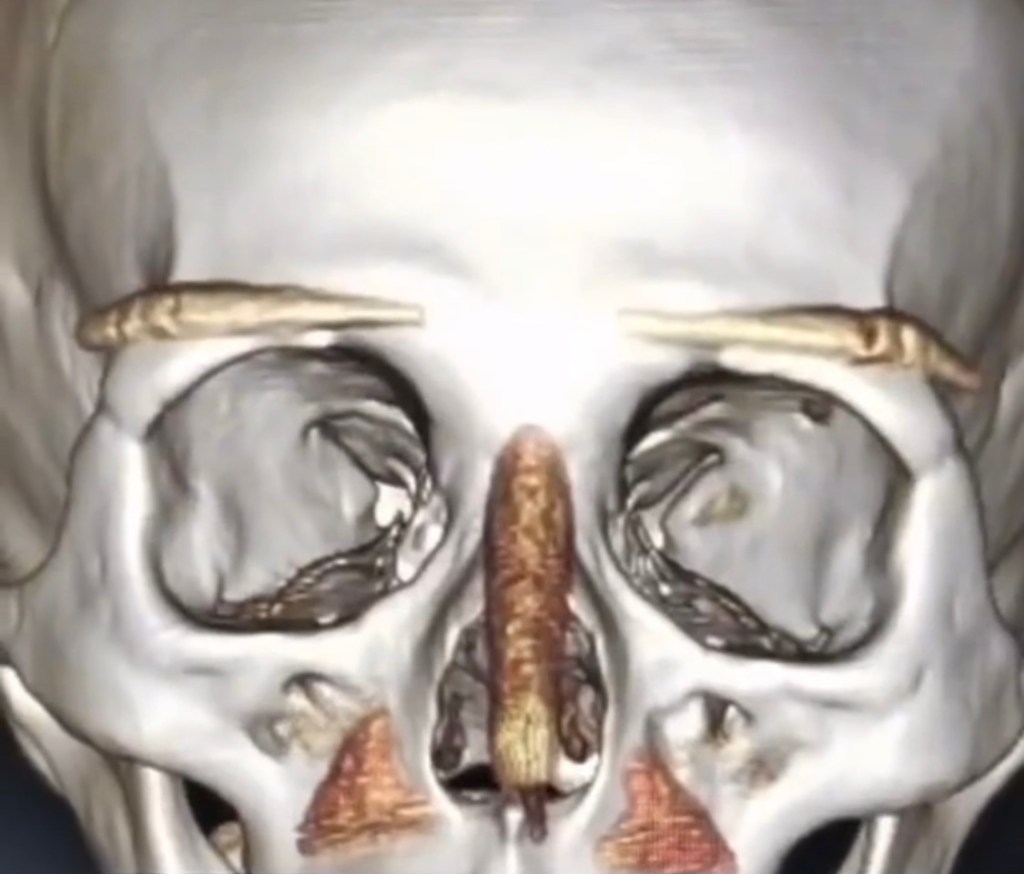 傳統墊眉骨的風險與禁忌