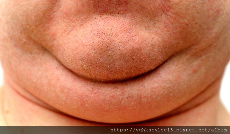 雙下巴分類和治療